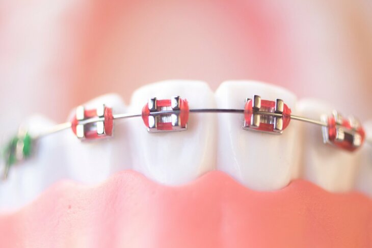 Kiedy warto udać się na leczenie ortodontyczne?